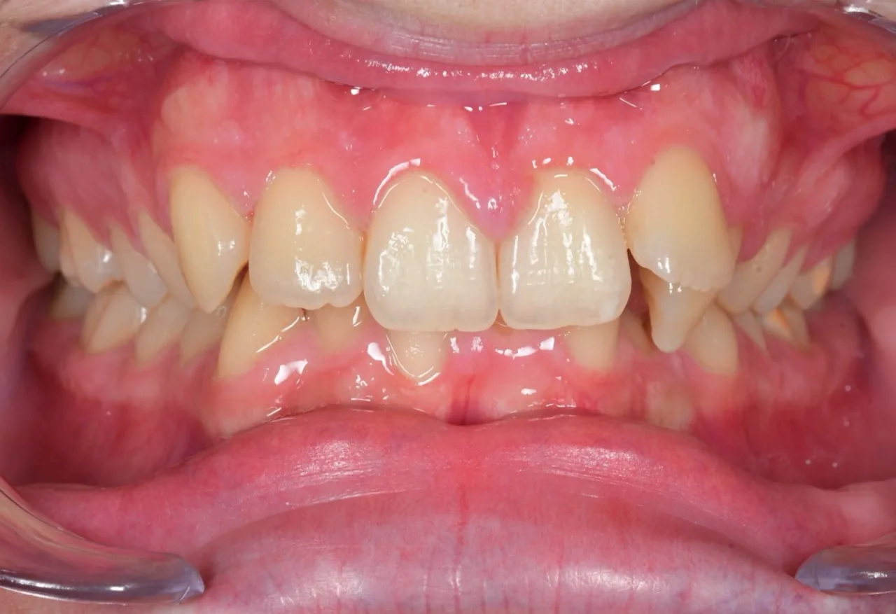 Before